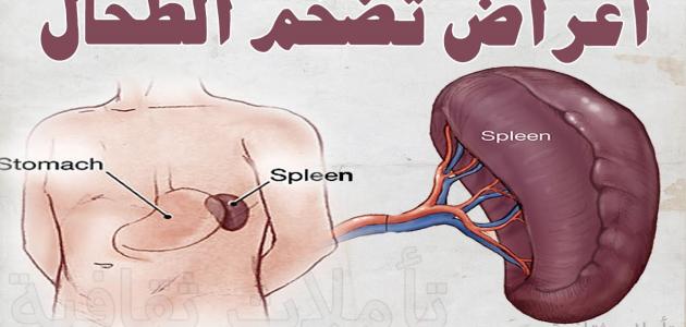 ما هي أمراض الطحال ما هي أمراض الطحال