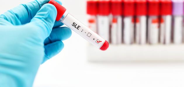 ما هي الذئبة الحمراء ما هي الذئبة الحمراء