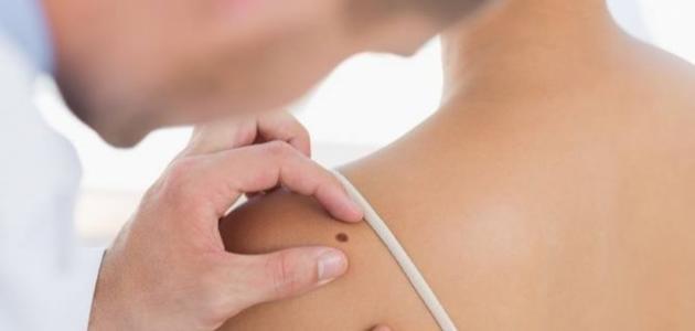 ما هي الشامات ولماذا تظهر - فيديو