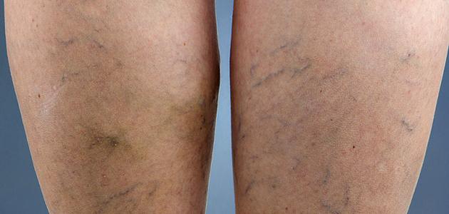 ما هي حقن التصليب لعلاج الدوالي ما هي حقن التصليب لعلاج الدوالي