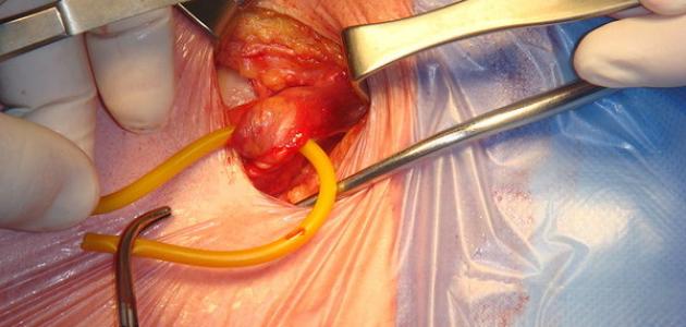 ما هي عملية الفتاق ما هي عملية الفتاق