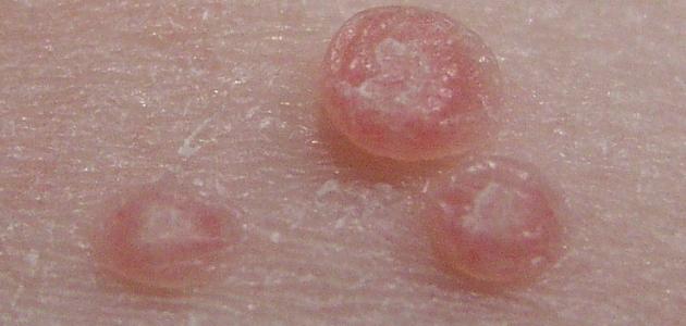 ما هي فطريات الجلد ما هي فطريات الجلد