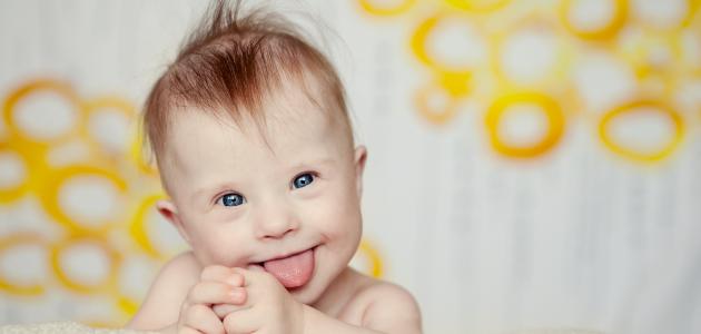 ما هي متلازمة داون ما هي متلازمة داون