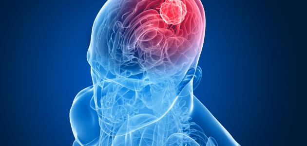 مراحل سرطان الدماغ