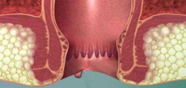 مرض الناسور مرض الناسور