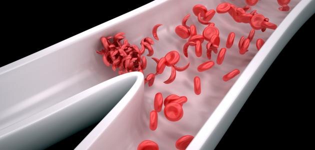 مرض فقر الدم المنجلي مرض فقر الدم المنجلي