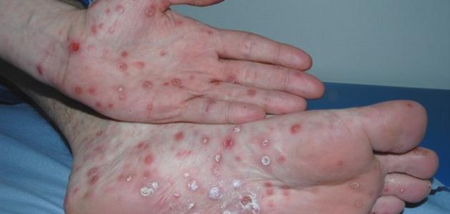 مضاعفات المرحلة الثانية من مرض الزهري مضاعفات المرحلة الثانية من مرض الزهري