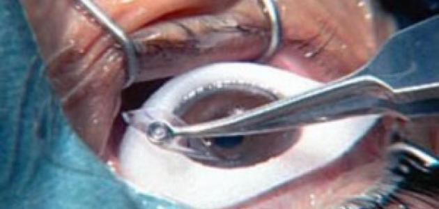 نصائح بعد عملية الليزك نصائح بعد عملية الليزك