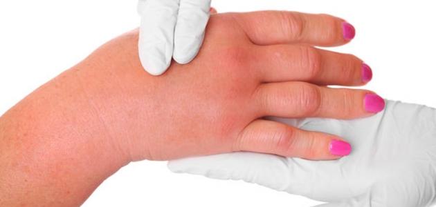 نقص الصوديوم في الجسم نقص الصوديوم في الجسم