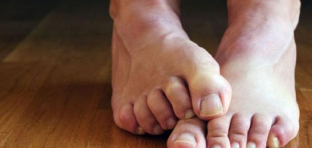 نقص المغنيسيوم في الجسم نقص المغنيسيوم في الجسم