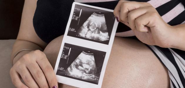 نقص حركة الجنين في الشهر الثامن نقص حركة الجنين في الشهر الثامن