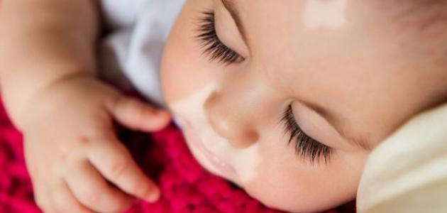 نقص صبغة الجلد عند الأطفال نقص صبغة الجلد عند الأطفال