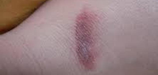 هل الليزر يزيل آثار الحروق