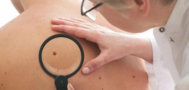 هل يجب إزالة الشامات عن الجسم - فيديو