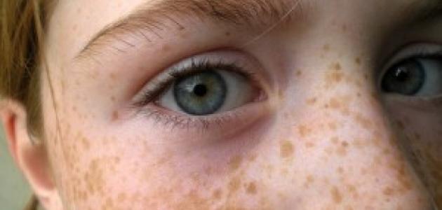 وصفة لإزالة النمش وصفة لإزالة النمش