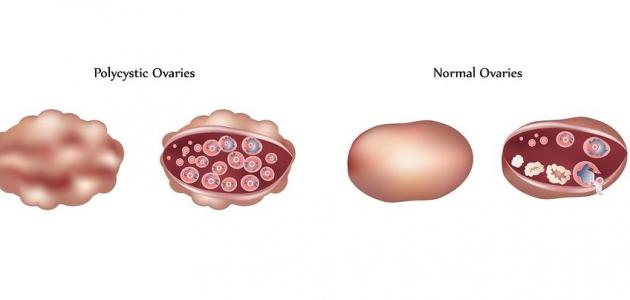 602eb4bca7848 ما هو تكيس المبايض