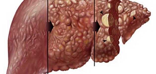 صورة ما هي أعراض تليف الكبد