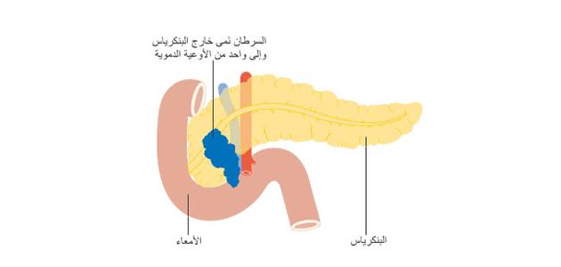 صورة أورام البنكرياس وأعراضه