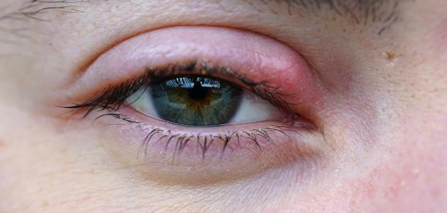 صورة التهاب جفن العين الخارجي