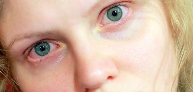 صورة أعراض التهاب جفن العين