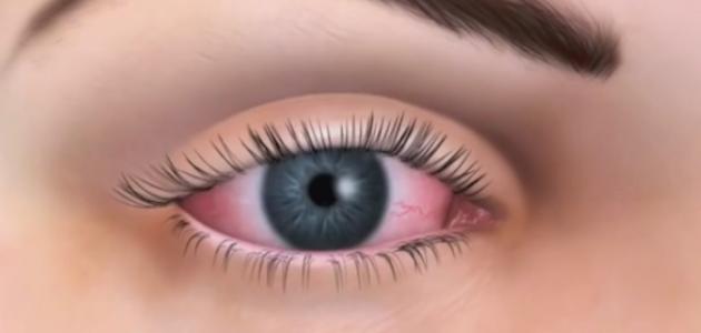 صورة ما هي أعراض جفاف العين