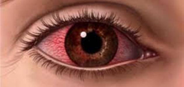 صورة ما علاج احمرار العين