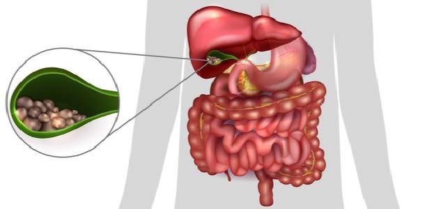 602f47ae6ccea كيفية علاج حصى المرارة
