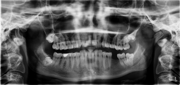 صورة جديد أضرار أشعة الأسنان للحامل