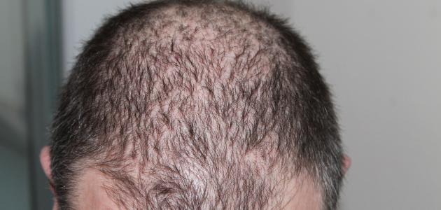 صورة جديد طريقة علاج تساقط الشعر عند الرجال