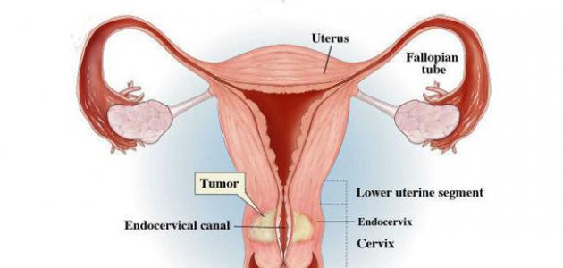 صورة جديد أعراض سرطان عنق الرحم المبكرة