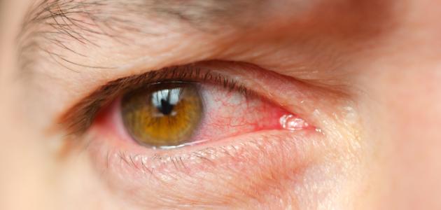 صورة جديد التهاب بياض العين
