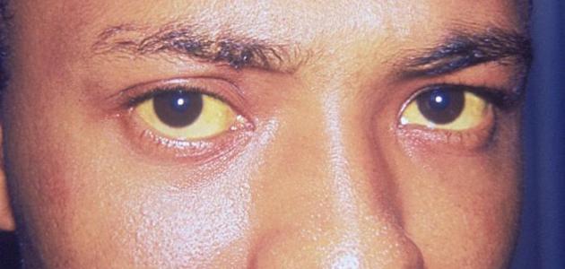 صورة جديد ما هو سبب اصفرار بياض العين