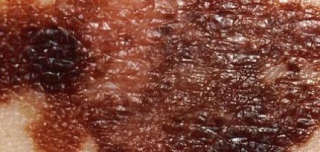 صورة جديد أسباب سرطان الجلد