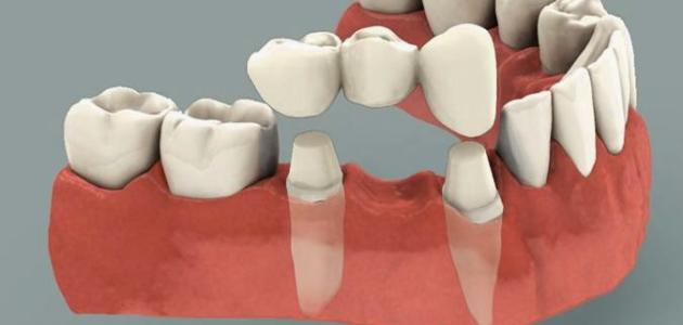 صورة جديد أنواع تركيبات الأسنان