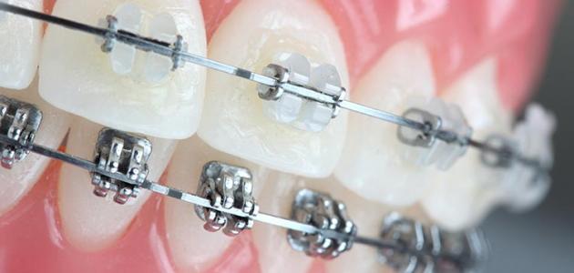 صورة جديد أنواع تقويم الأسنان