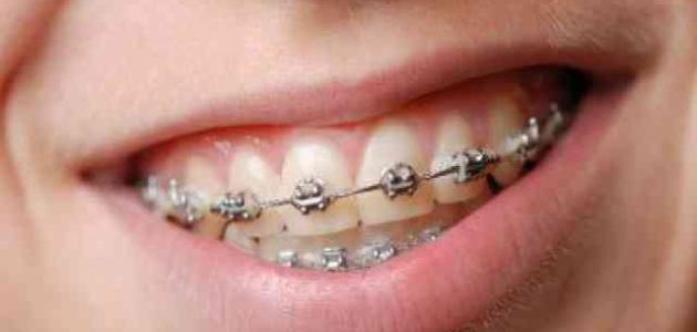 صورة جديد مراحل تقويم الأسنان