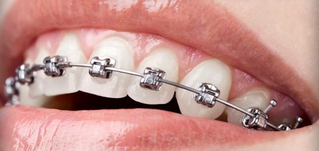 صورة جديد فوائد تقويم الأسنان