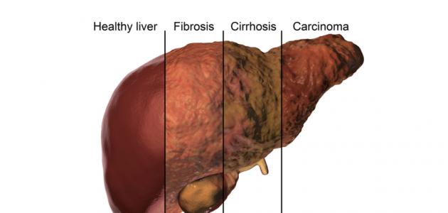 60328c3cd6fce جديد الفرق بين تشمع الكبد وتليف الكبد