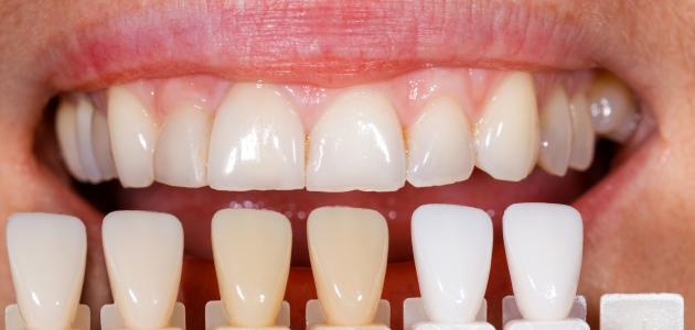 6033a187c6d23 جديد تغيّر لون الأسنان، الأسباب والعلاج