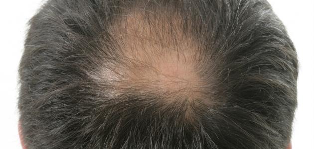 صورة جديد الصلع وزراعة الشعر