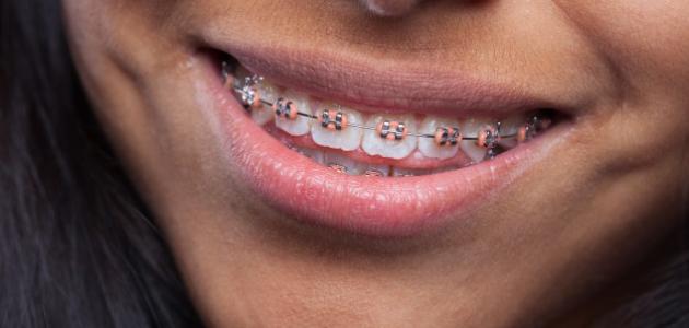 صورة جديد فوائد وأضرار تقويم الأسنان