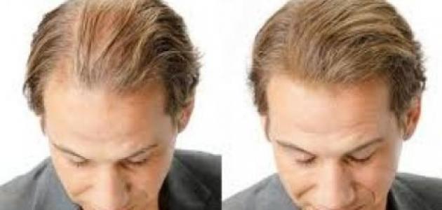 صورة جديد حلول لعلاج تساقط الشعر