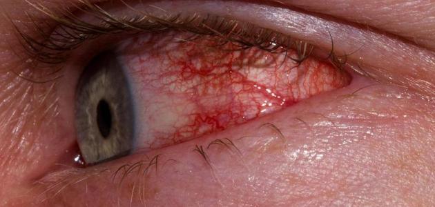 صورة جديد التهاب العين الفيروسي