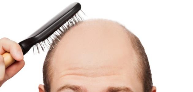 صورة جديد ما هي الأمراض التي تسبب تساقط الشعر
