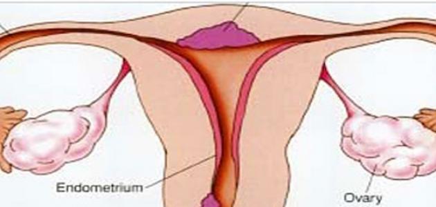 صورة جديد ما هي أعراض جرثومة الرحم
