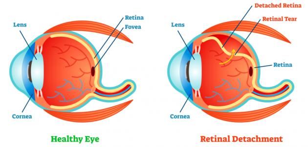 صورة جديد ما هي أمراض شبكية العين