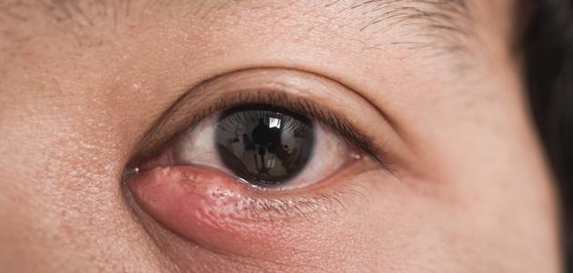 صورة جديد التهاب العين البكتيري