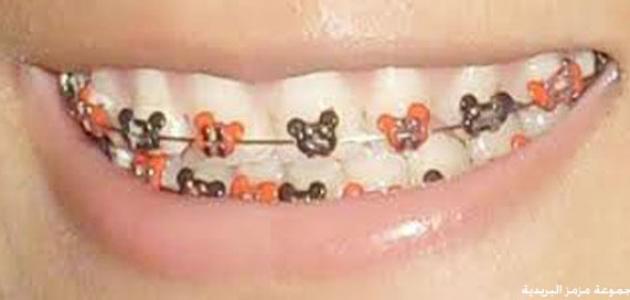 صورة جديد طريقة تركيب تقويم الأسنان