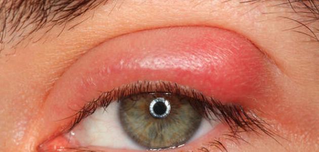 صورة جديد علاج انتفاخ جفن العين العلوي