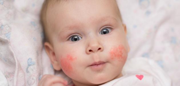 صورة جديد أعراض حساسية البيض عند الرضع